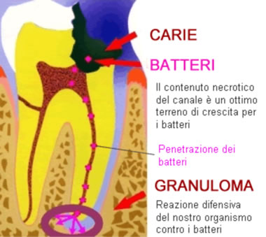 Trattamento endodontico