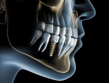 Chirurgia implantare