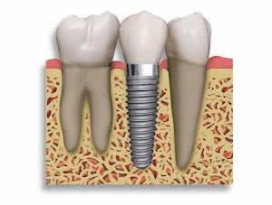 Chirurgia implantare