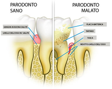 Chirurgia paradontale