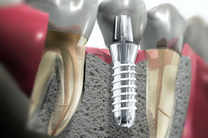 Chirurgia e implantologia orale