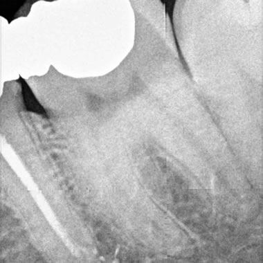 Trattamento endodontico
