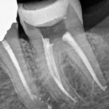 Trattamento endodontico